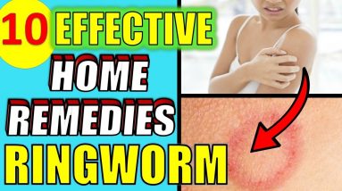 10 Effective Home Remedies For Ringworm (NATURAL HOME TREATMENTS)